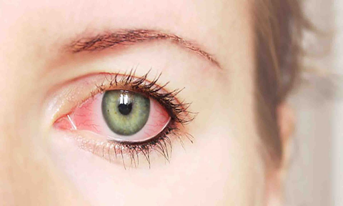 What is Pink Eye?
