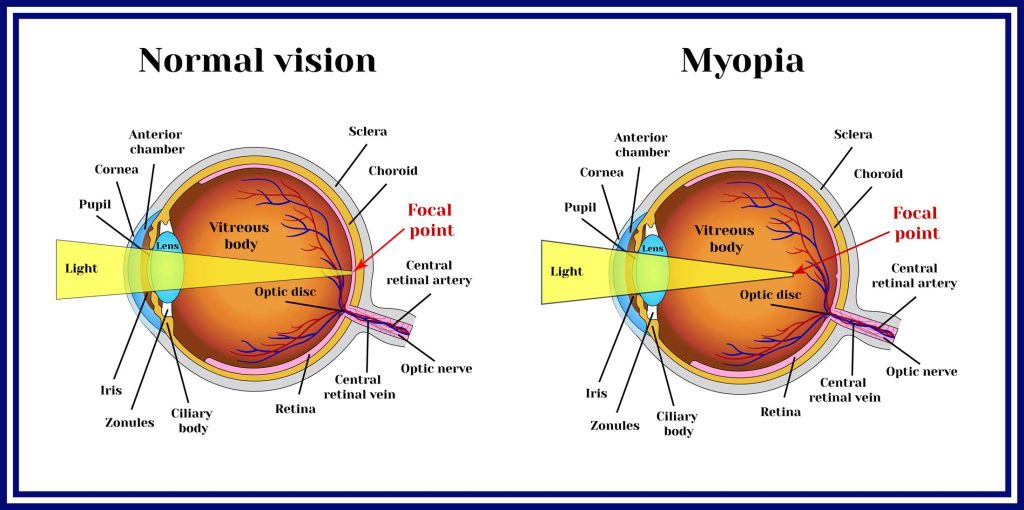 Normal eye compared to an eye with myopia