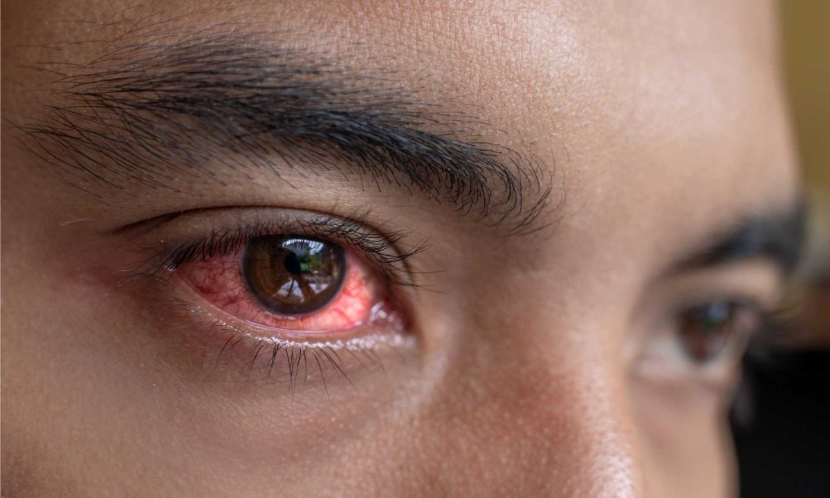 Exploring the Root Causes of Eye Irritation