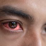 Exploring the Root Causes of Eye Irritation